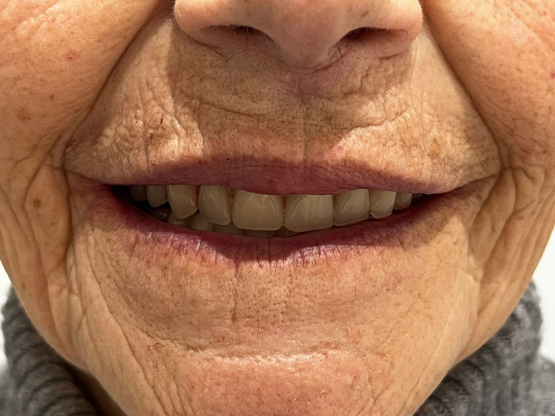 Implante dental en Vigo