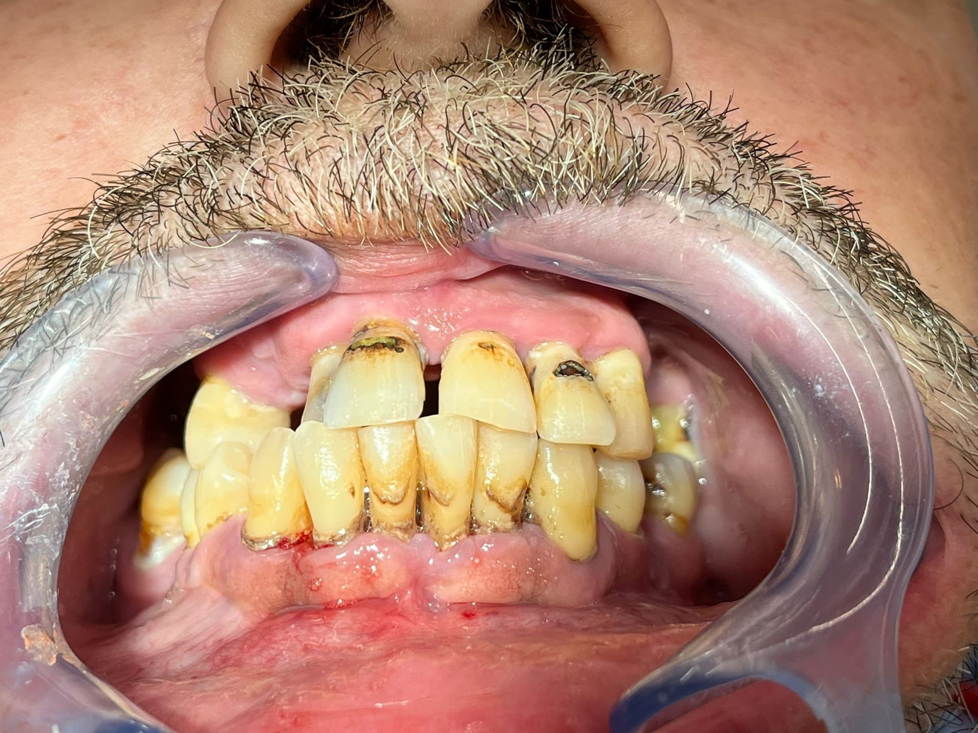Implante dental en Vigo